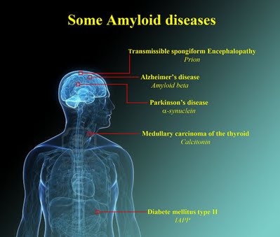 Image:Amyloid-disease.jpg