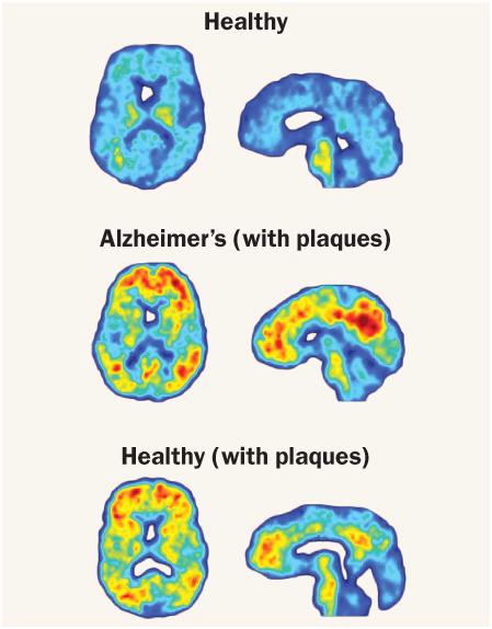Image:Alzheimers.JPG