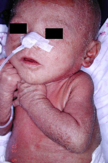 Image:Omenn's_Baby.jpg