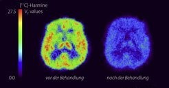 Image:Postpardam depression maoa.jpg
