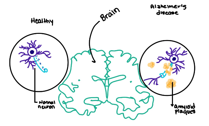 Image:Amylin role in Alzheimers.png
