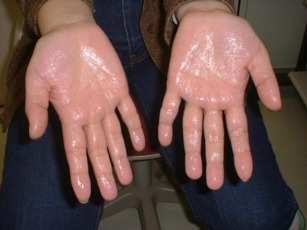 Image:Hyperhidrosis.jpg