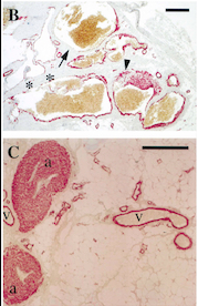 Image:Venous Malformations Immunohistochemistry.jpg