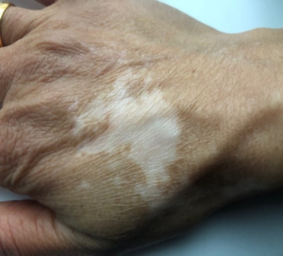 Image:Vitiligo.jpg