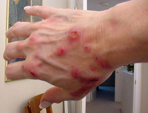 Image:Lyme-disease-8.jpg