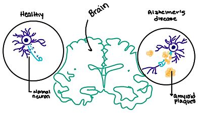 Figure 8. Amylin's effect on the brain through the buildup of amyloid plaques.