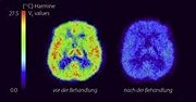 ”Positron-Emission-Tomography (PET) of a depressive patient with elevated monoamine-oxidase-A-levels (green, yellow, red) without medication (left) and after a six-week-treatment with the monoamine-oxidase-A-inhibitor moclobemid (right)” [1]