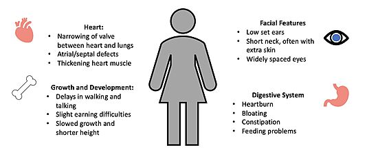 Figure 4. Common Symptoms of Noonan Syndrome. 