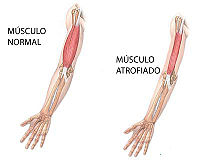 Comparacion de la degeneracion muscular, 1dxx
